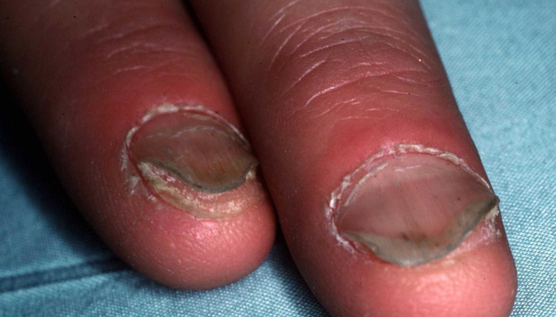 Imagen: Dermquest